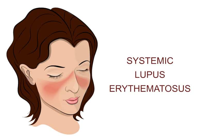 Illustration of the main symptom of Lupus: a rash in the form of a butterfly on the nose and cheeks