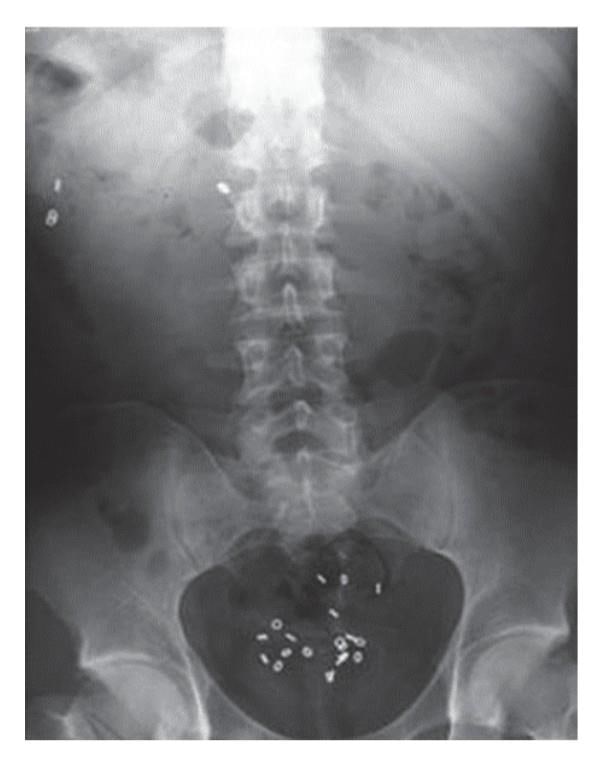 X-ray of the pelvis and lumbar spine region